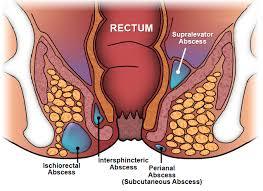 Fistula in Ano