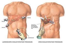 Stone Gall Bladder
