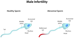 Male Infertility treatment