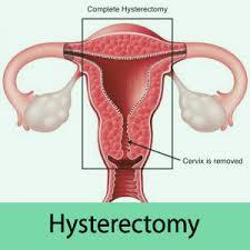 Hysterectomy Surgery