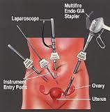 Laparoscopic Surgery