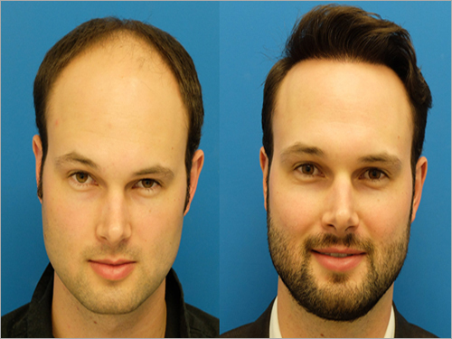 Hair Bonding Services In Lajpat Nagar Hair Weaving Services In Delhi