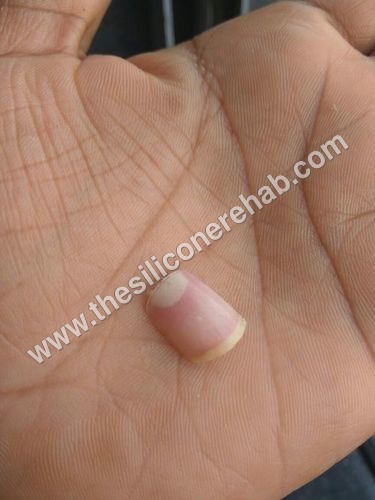 Painted Acrylic Nail For Prosthetics Fingers