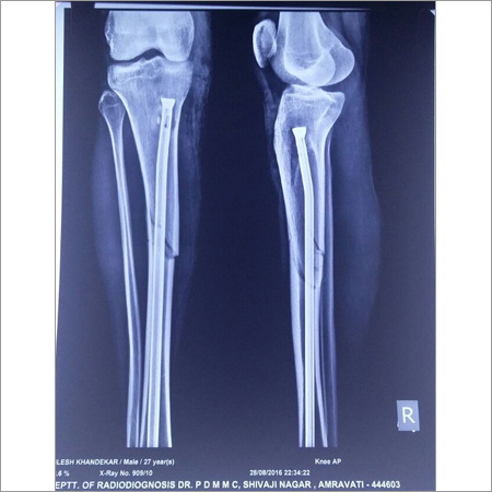 KPD Titanium Nailing