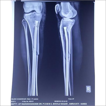 Titanium Interlocking Nail