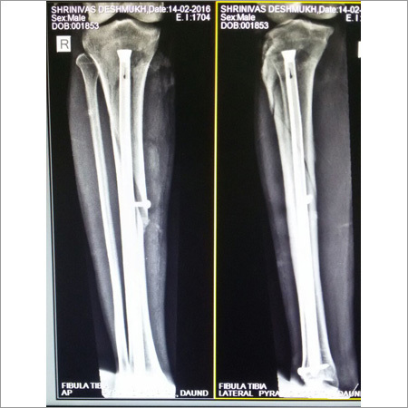 KPD Titanium interlocking Nail