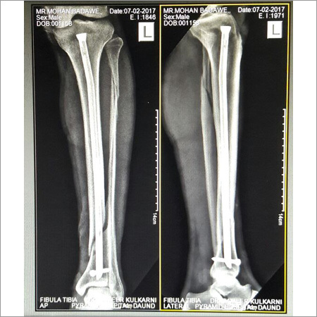 KPD Daga Titanium Nail