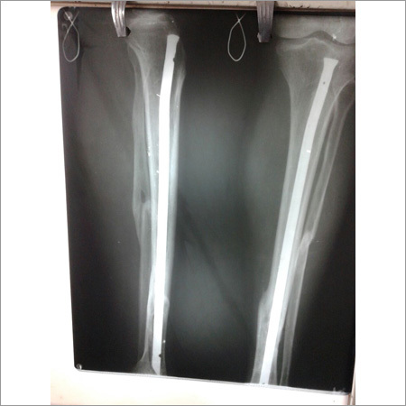 KPD DAGA Titanium Nail