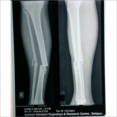 KPD Preoperative Fracture Tibia for Daga Naling