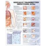 CHART, AIDS - Non-Tearing Plastic Sheet, 75x100 cm , Weatherproof and Washable with Markable Surface and Plastic Rollers