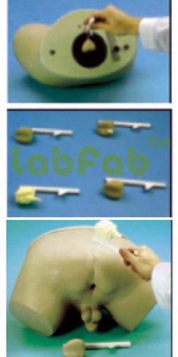 PROSTATE INSPECTION MODEL - Resin, Solid | Tumor Stages, Visual Aid, Training Tool, Realistic Texture