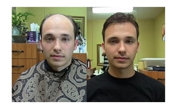 Hair Transplant in Kolkata