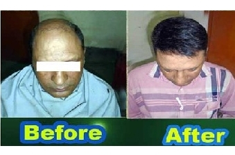 Hair Weaving Center in Kolkata