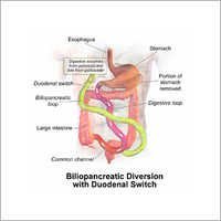 Bariatric Surgery - 30mm Stomach Pouch, Intestinal Redirection | Weight Loss, Appetite Control, Metabolic Boost, Hormonal Changes