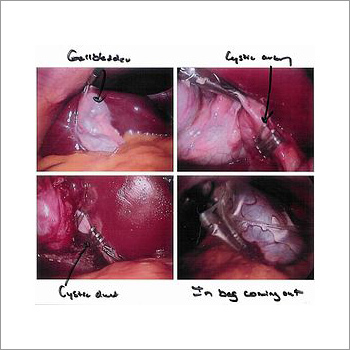 Laparoscopic Surgery