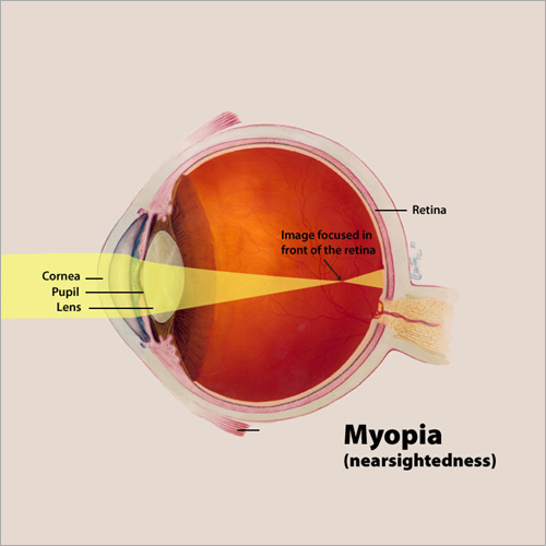 Myopia