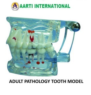 White Adult Pathology Tooth Model