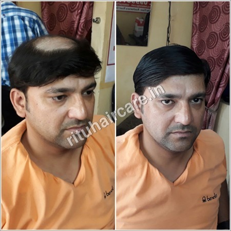 Hair Replacement Shop