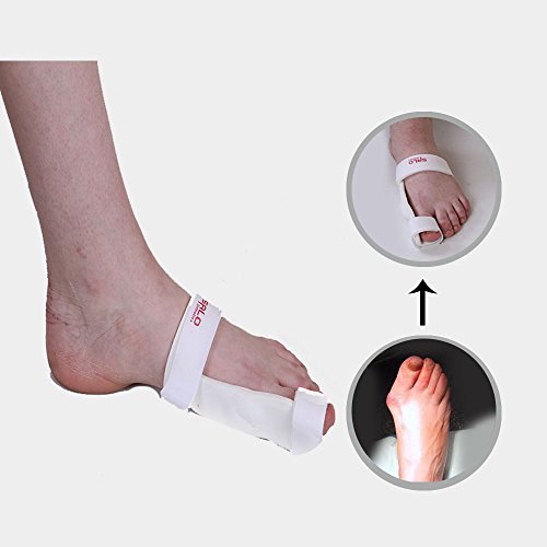 HALLUX VALGUS HALLUX VALGUS