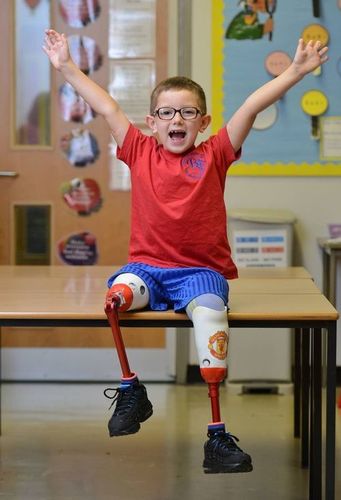 Artificial Limbs For Children