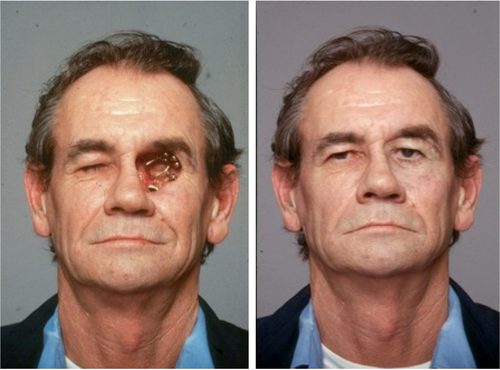 Maxillo Facial Prosthesis