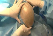 Craniotomy Drapes