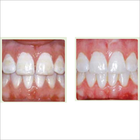 Teeth Invisible Aligners