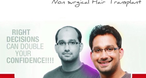 Non Surgical Hair Transplant