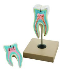 Upper Triple Root Molar With Caries Model, Enlarged 15 Times, 2 Parts