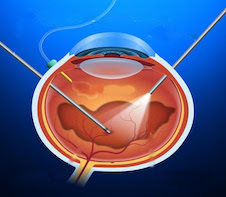 Vitrectomy Cutter