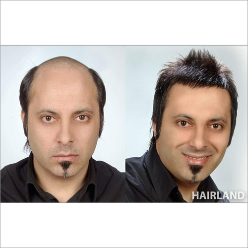 Hair Replacement Service Provider in New Delhi,India