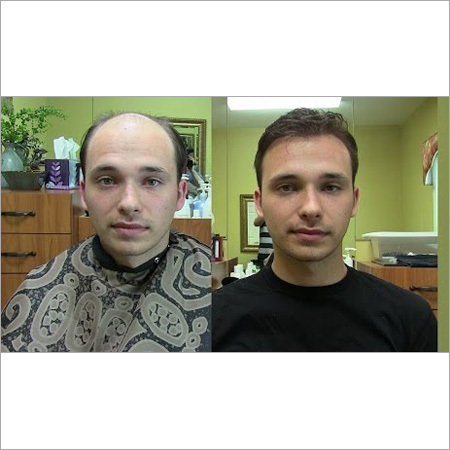 Mens Hair Replacement Services