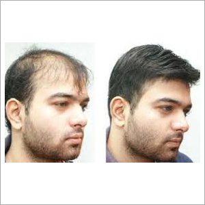 Non Surgical Hair Replacement Services