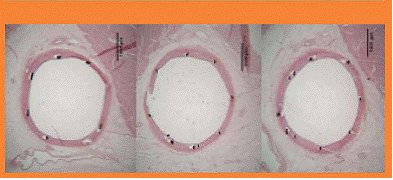 Vestasync Sirolimus Eluting Stent