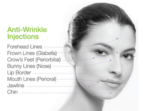 Anti wrinkle injections