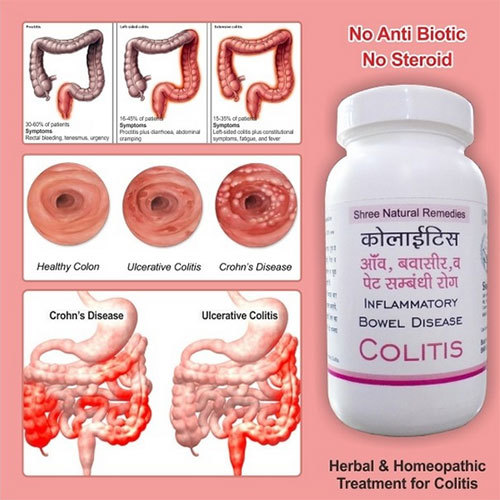 Colitis Medicine