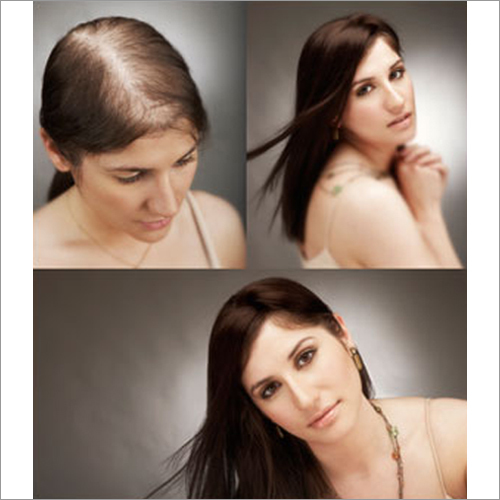 Hair Patch In Kolkata, West Bengal At Best Price | Hair Patch  Manufacturers, Suppliers In Calcutta