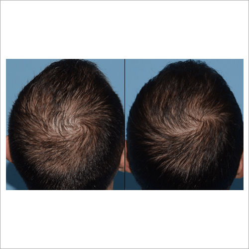 Platelet Rich Plasma Hair Therapy Services