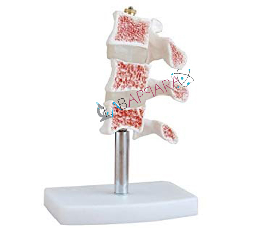 Human Cutaway Osteoporosis Model
