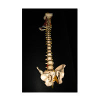 Pathological Spine Model