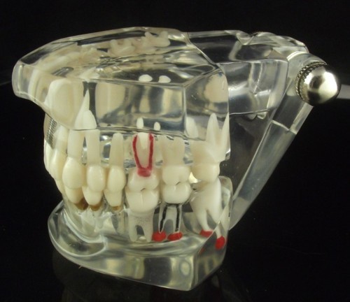 Implant Model