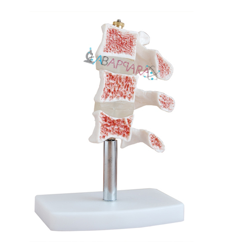 Cutaway Osteoporisis (Fibre Glass Models)