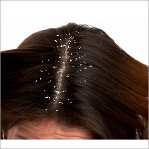 Scalp Peeling Scalp Peeling