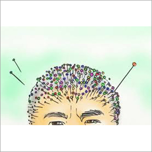 Acupuncture Hair Therapy