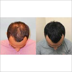 PRP Hair Growth