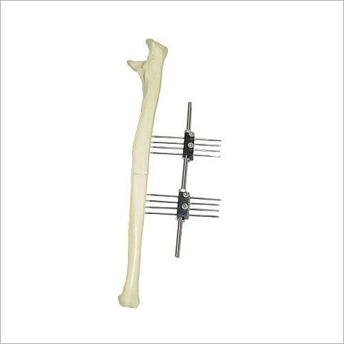 External Fixtion Device - Metal, Adjustable Design | Durable Stabilization for Fractured Bones, Optimal Alignment During Healing Process