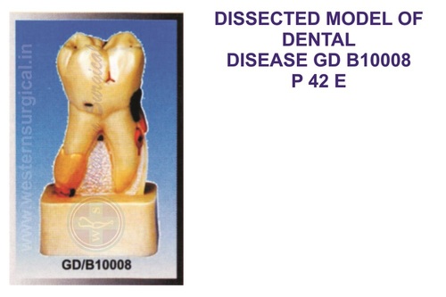 DISSECTED MODEL OF DENTAL DISEASE GD B10008