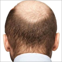 Non Surgical Hair Replacement Service in Manimajra, Chandigarh - Look Masters Non Surgical Hair Replacement Service in Manimajra, Chandigarh - Look Masters
