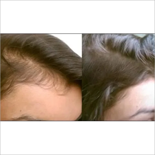 Hair Growth Serum