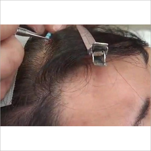 Hair Replacement Treatment